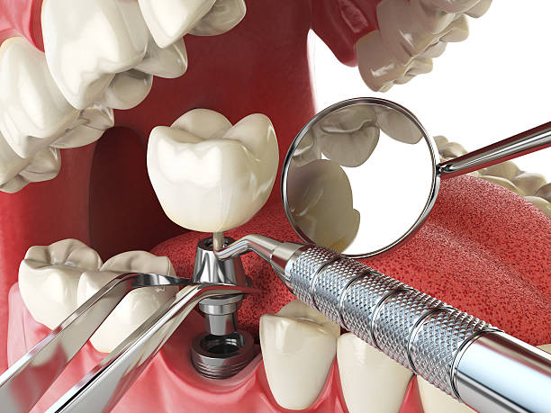 Best Emergency Dentist for Knocked-Out Tooth in Mount Prospect, IL